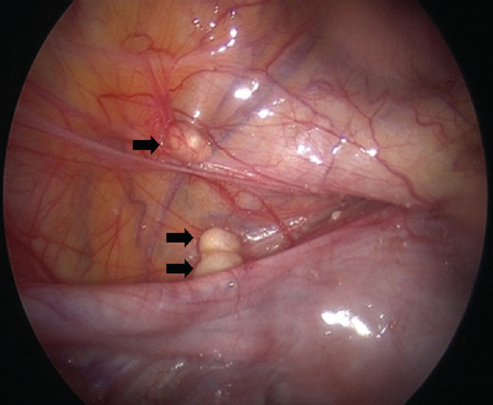 Laparoscopy showing caseous nodules in uterovesical pouch (single arrow) and on anterior abdominal wall (double arrow).